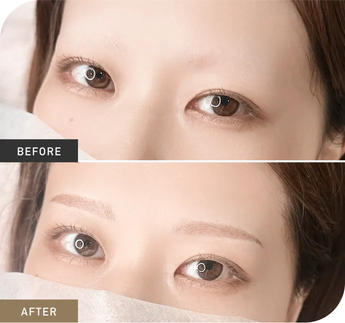 症例1 Before After