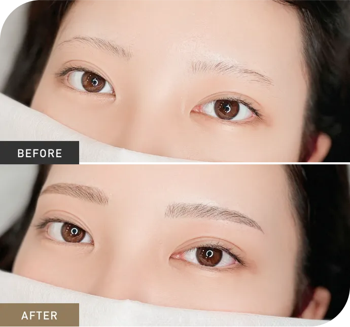 症例2 Before After