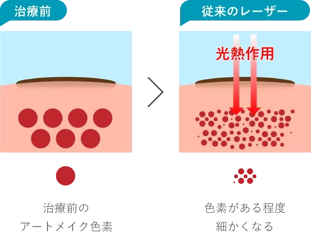 治療前治療前のアートメイク色素従来のレーザー光熱作用色素がある程度細かくなる