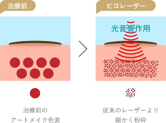 治療前治療前のアートメイク色素ピコレーザー光音響作用従来のレーザーより細かく粉砕