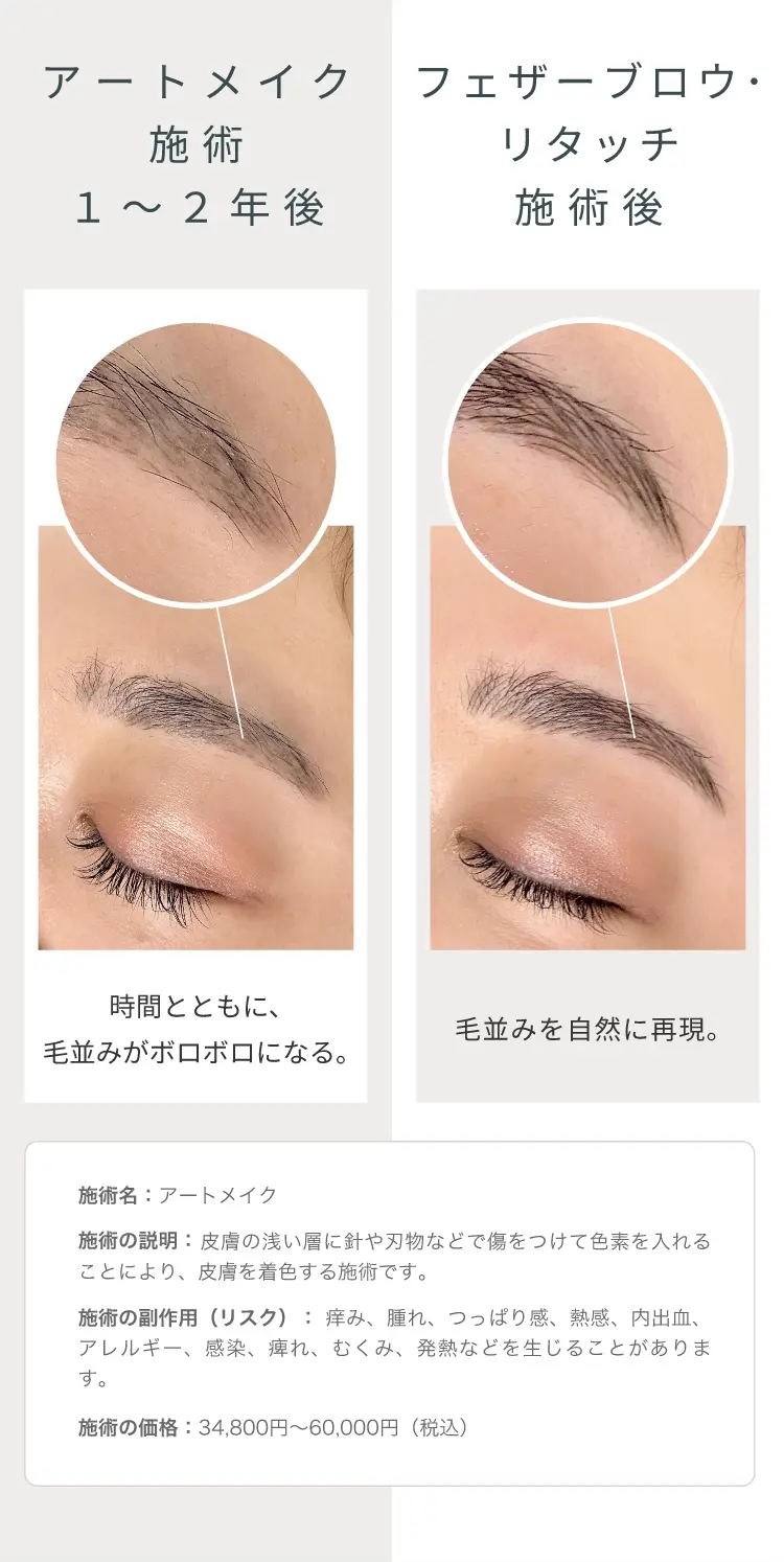 アートメイク施術1~2年後時間とともに、毛並みがボロボロになる。フェザーブロウ・リタッチ施術後毛並みを自然に再現。 施術名:アートメイク施術の説明:皮膚の浅い層に針や刃物などで傷をつけて色素を入れることにより、皮膚を着色する施術です。施術の副作用(リスク):痒み、腫れ、つっぱり感、熱感、内出血、アレルギー、感染、痺れ、むくみ、発熱などを生じることがあります。施術の価格:34,800円~60,000円(税込)