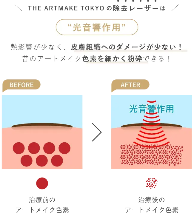 THE ARTMAKE TOKYOの除去レーザーは“光音響作用”熱影響が少なく、皮膚組織へのダメージが少ない!昔のアートメイク色素を細かく粉砕できる!BEFORE治療前のアートメイク色素AFTER光音響作用治療後のアートメイク色素