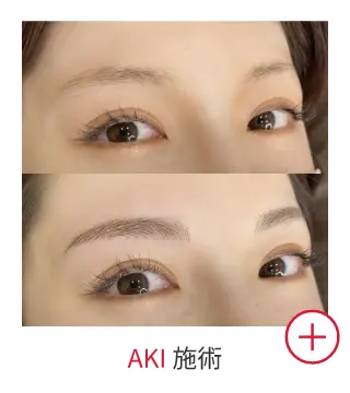 AKIの症例写真