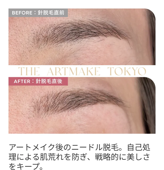 アートメイク後のニードル脱毛。自己処理による肌荒れを防ぎ、戦略的に美しさをキープ。
