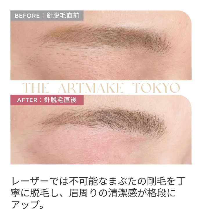 レーザーでは不可能なまぶたの剛毛を丁寧に脱毛し、眉周りの清潔感が格段にアップ。