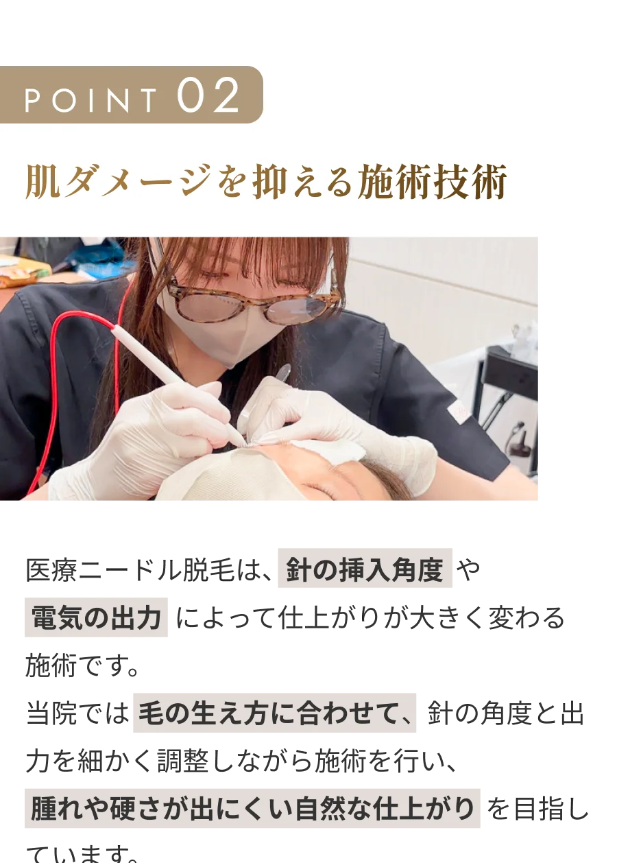 POINT 02 肌ダメージを抑える施術技術 医療ニードル脱毛は、針の挿入角度や電気の出力によって仕上がりが大きく変わる施術です。当院では毛の生え方に合わせて、針の角度と出力を細かく調整しながら施術を行い、腫れや硬さが出にくい自然な仕上がりを目指しています。