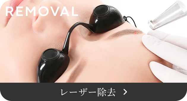 レーザー除去