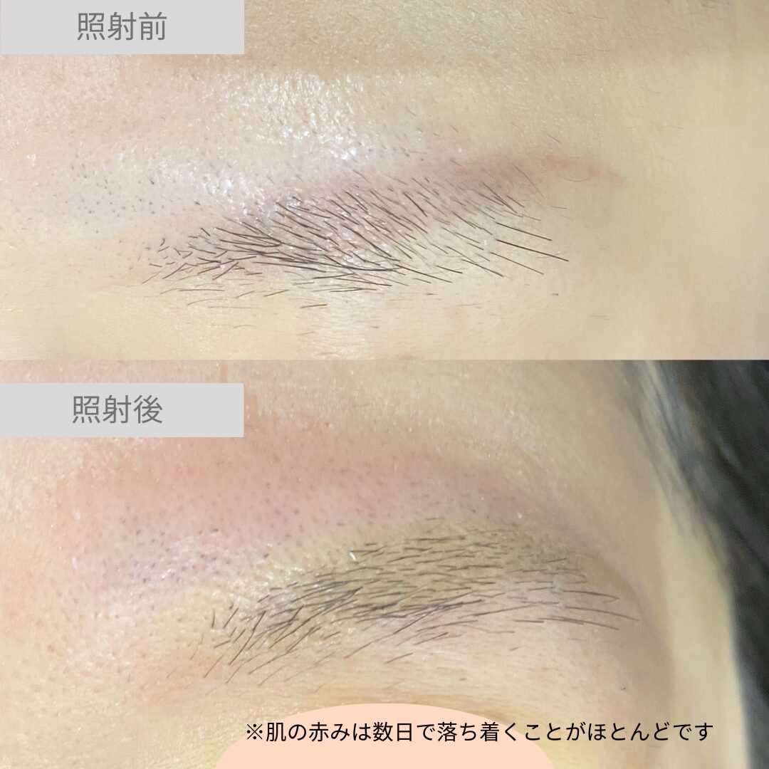 赤いアートメイクに対するアートメイク除去